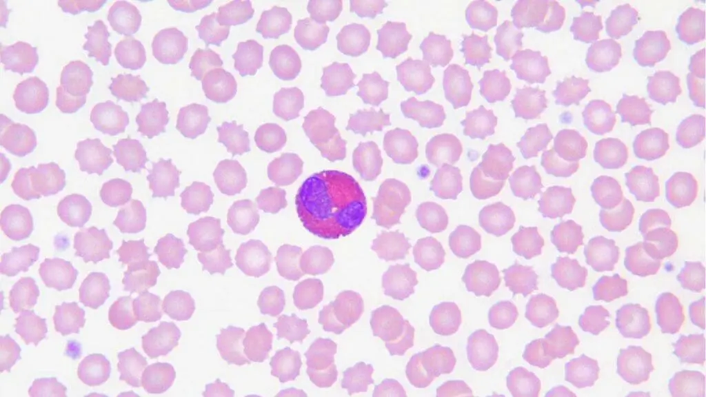 An eosinophil in the peripheral blood smear.