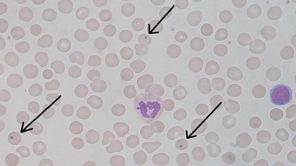 Howell-Jolly inclusion bodies in the red cells pointing to a potential problem in the spleen.