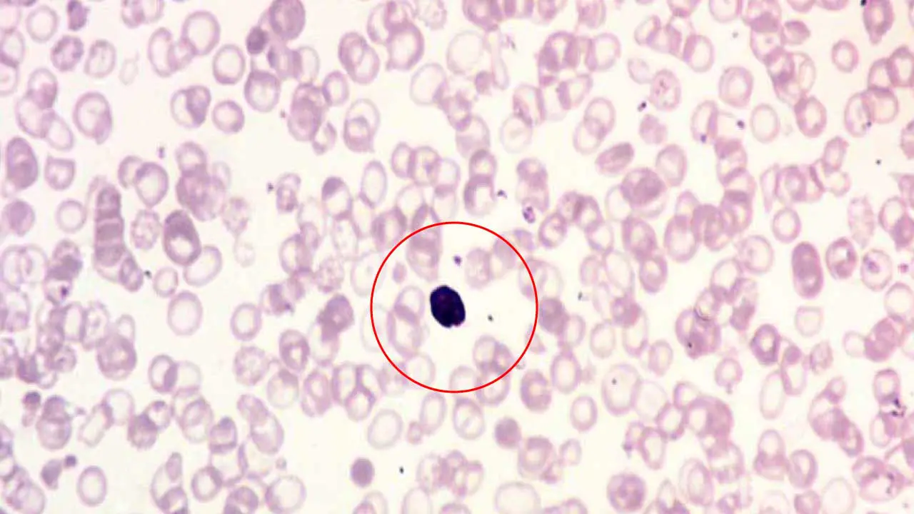 This blood smear image showcases the hallmarks of severe anemia. The large, centrally nucleated red blood cell (NRBC) indicates the bone marrow is releasing immature cells in an attempt to compensate for a lack of healthy red blood cells. Nucleated red blood blood cells as the name implies still has compacted nucleus as inclusion bodies in the red cell.
