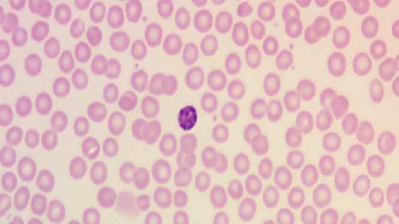 Normal RBC morphology with approximately 1/3 central pallor, a characteristic reflecting the unique biconcave shape of the RBCs using the Leishman stain. The average diameter is approximately 7.2 μm (6.7–7.7 μm). A small lymphocyte in the middle can be used as a subjective measurement of the RBC size.