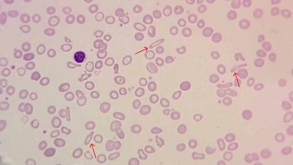 A blood smear containing several elongated, pencil-shaped red blood cells alongside anisopoikilocytic red cells. These pencil shaped cells are a characteristic red blood cell morphology finding in iron deficiency anemia.