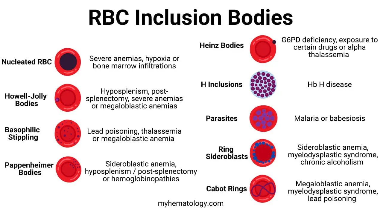 Red blood cell inclusion bodies are abnormal aggregates of material within the cytoplasm of red blood cells, which are visible under a microscope and are indicative of various underlying diseases or conditions.