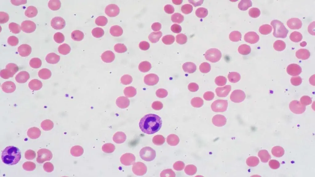 Numerous spherocytes in the peripheral blood smear that can be seen in warm AIHA