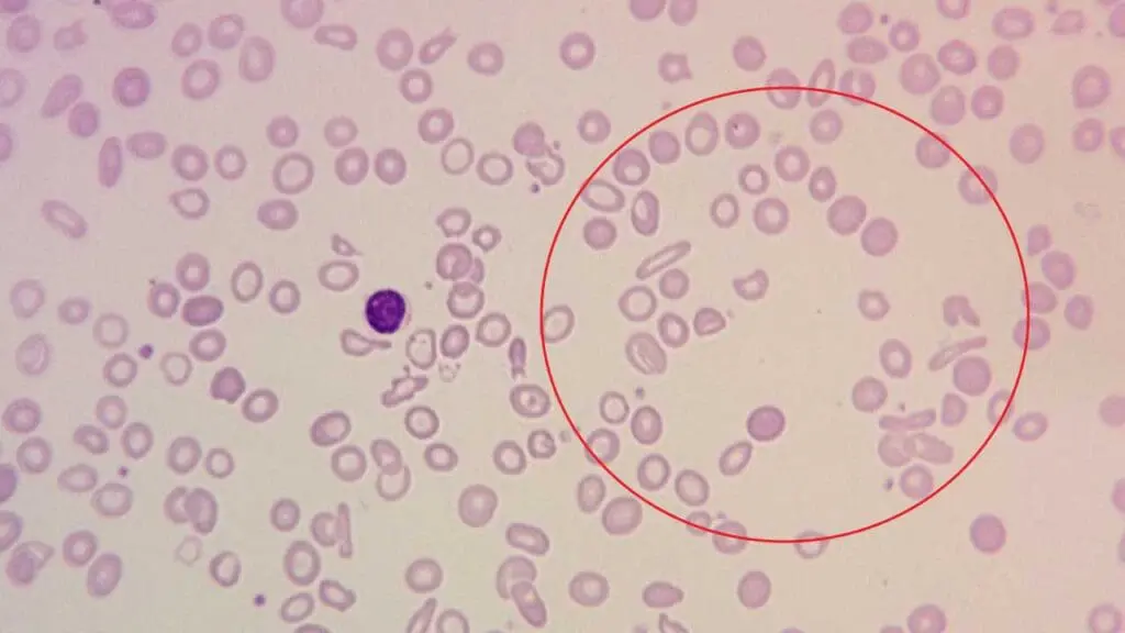 The presence of marked anisopoikilocytosis in red blood cell morphology of severe anemia highlights the severity of the condition and the potential urgency for diagnosis and treatment.