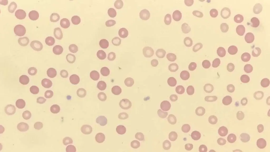 Peripheral blood smear showing dimorphic red blood cell morphology after a blood transfusion