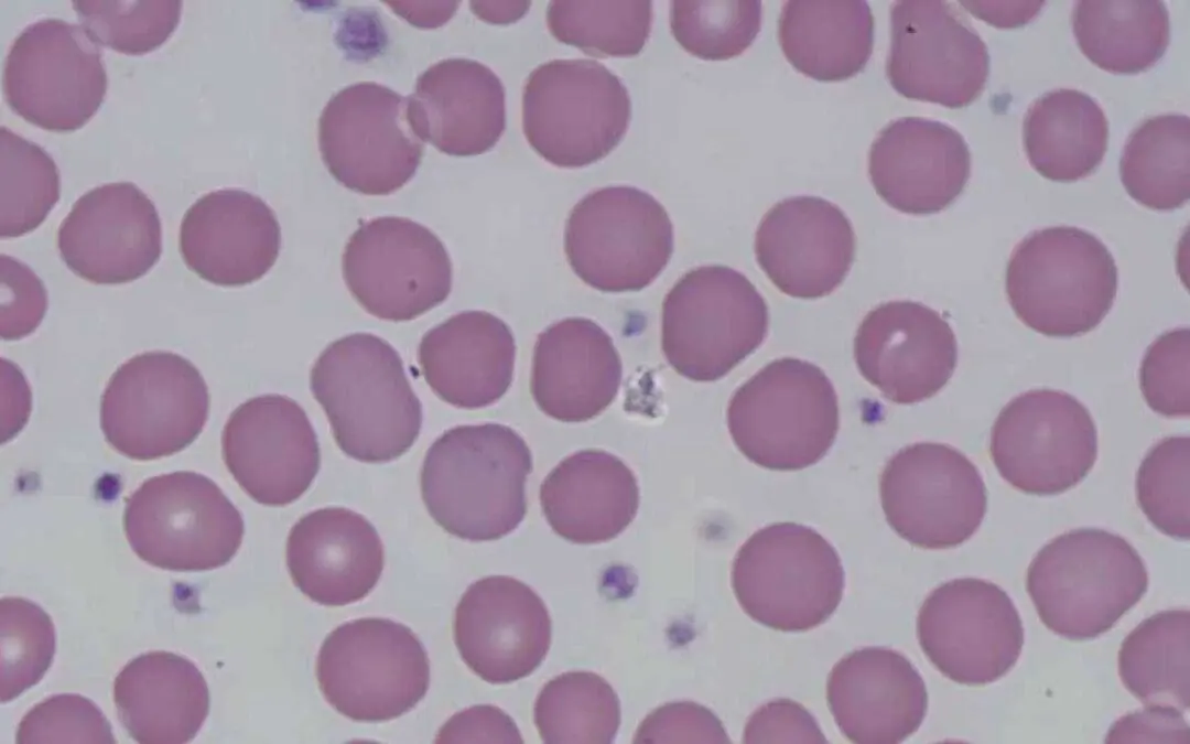 Differential Diagnosis of Macrocytic Anemias