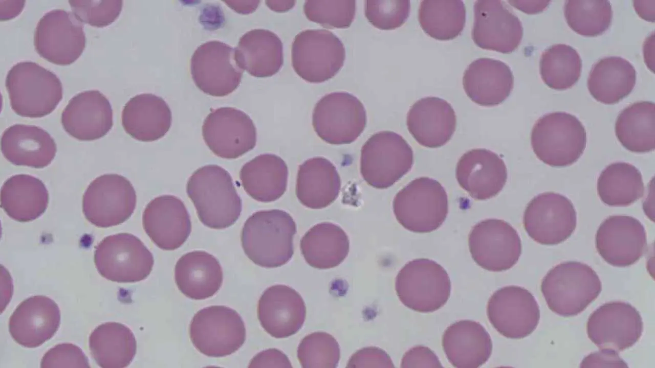 Differential Diagnosis of Macrocytic Anemias