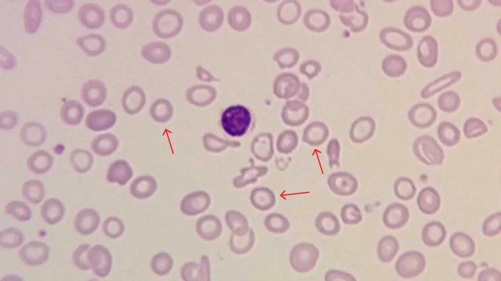 A peripheral blood smear of microcytic RBCs (microcytes), appearing smaller than a normal lymphocyte in the center for size comparison (red arrows). The RBC is smaller than 7.2 µm in diameter, biconcave shape and increased central pallor. These smaller, rounder cells are characteristic of iron deficiency anemia and thalassemias, conditions that limit hemoglobin production.