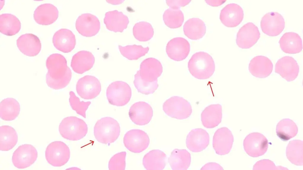 Normochromic red cells are not only present in healthy blood smears but can also be present in normochromic anemias like hemolytic anemias.