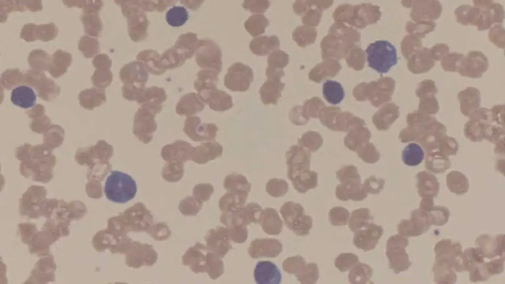 Rouleaux formation, pronounced "roo-loh," is a phenomenon observed on a peripheral blood smear where red blood cells (RBCs) appear stacked face-to-face, resembling stacks of coins.