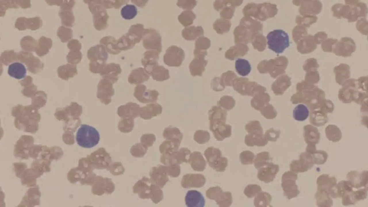 Rouleaux formation, pronounced "roo-loh," is a phenomenon observed on a peripheral blood smear where red blood cells (RBCs) appear stacked face-to-face, resembling stacks of coins in the red blood cell morphology.