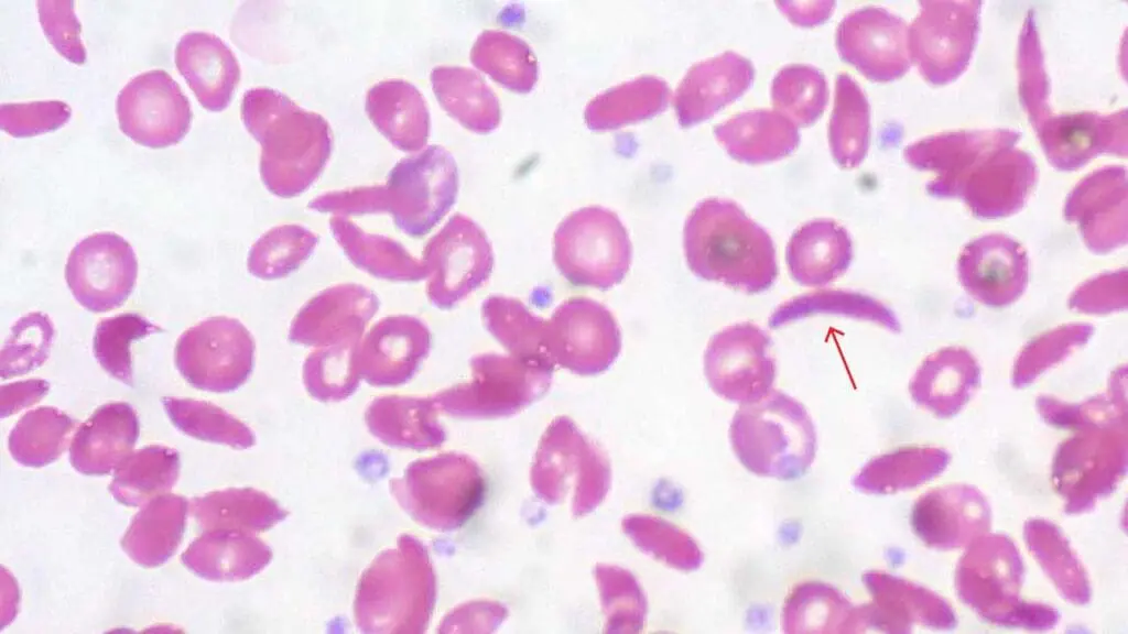 Sickle cells are a characteristic red blood cell morphology in sickle cell disease