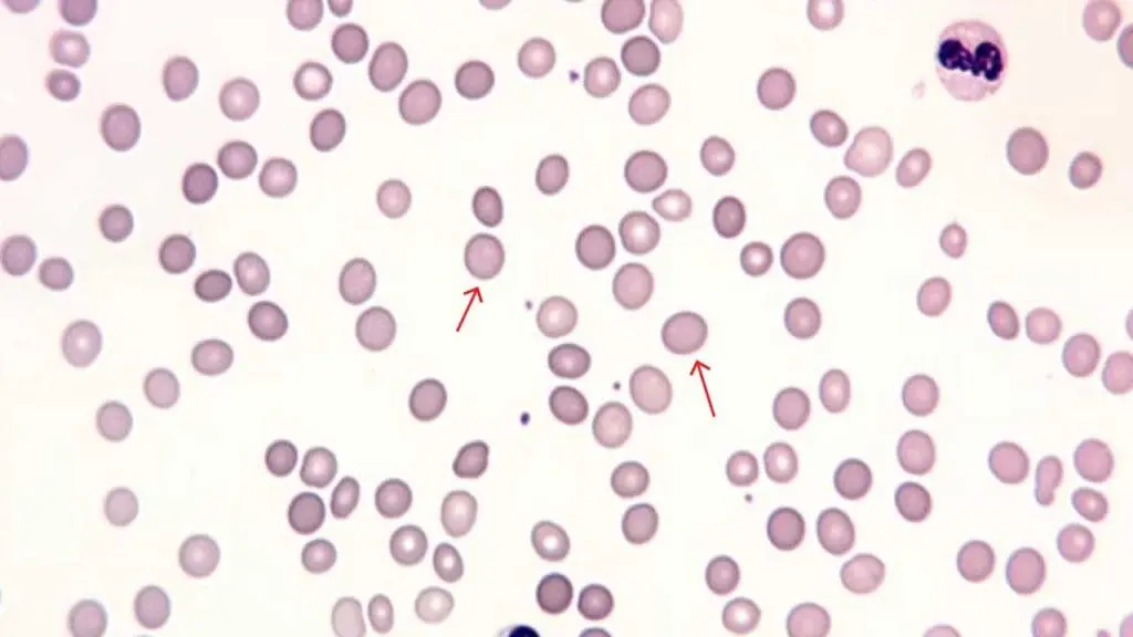 Spherocytes are a type of red blood cell morphology that are overly round or spheroid in shape instead of being biconcave shape. It is normally seen in the peripheral blood smear of an individual with hereditary spherocytosis