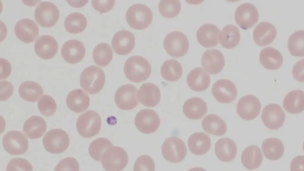 Stomatocytes red blood cell morphology in the peripheral blood smear can be seen in hereditary stomatocytosis.