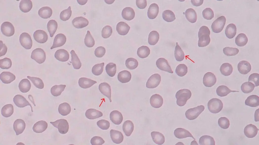 Numerous teardrop red blood cell morphology on a peripheral blood smear