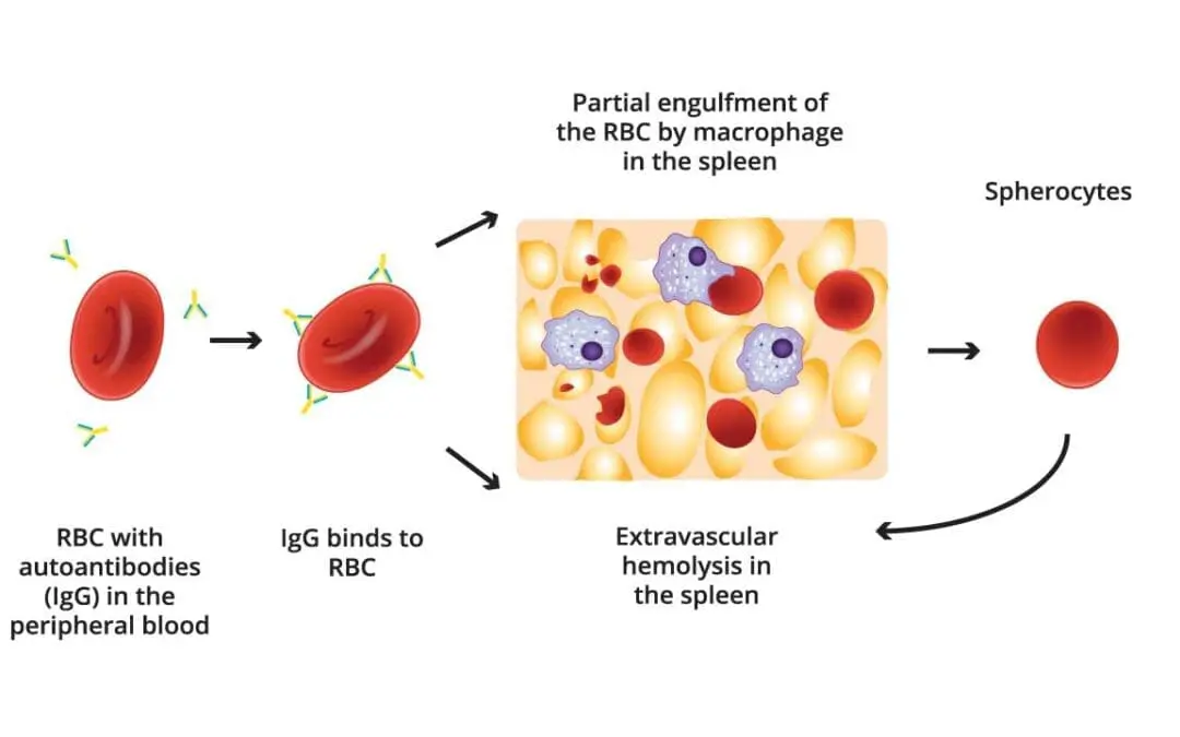 Autoimmune Hemolytic Anemia (AIHA)