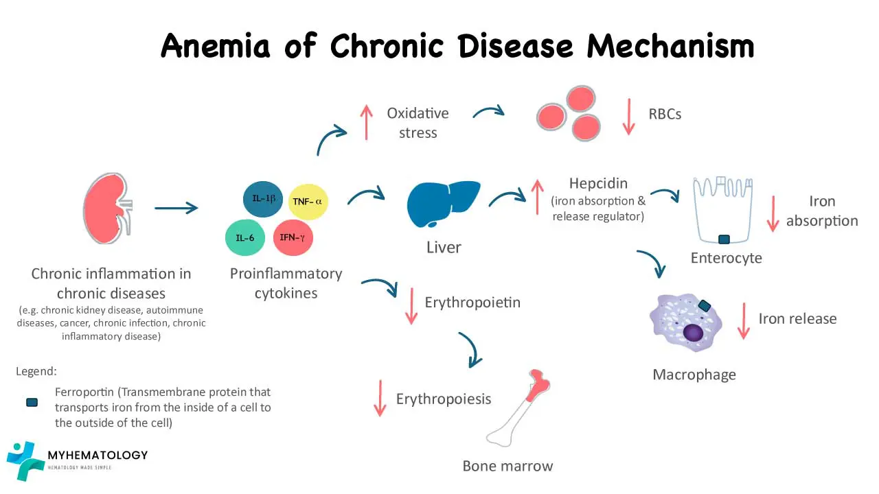 Anemia of Chronic Disease (Anemia of Inflammation)