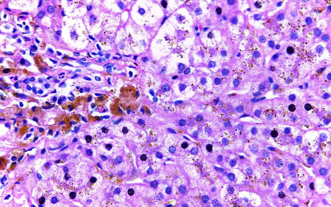Hereditary Hemochromatosis