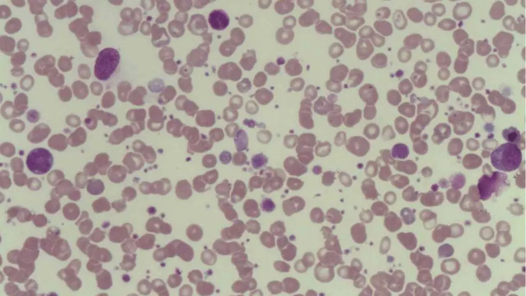 Giant platelets can be seen in the peripheral blood smear in Bernard-Soulier syndrome. 