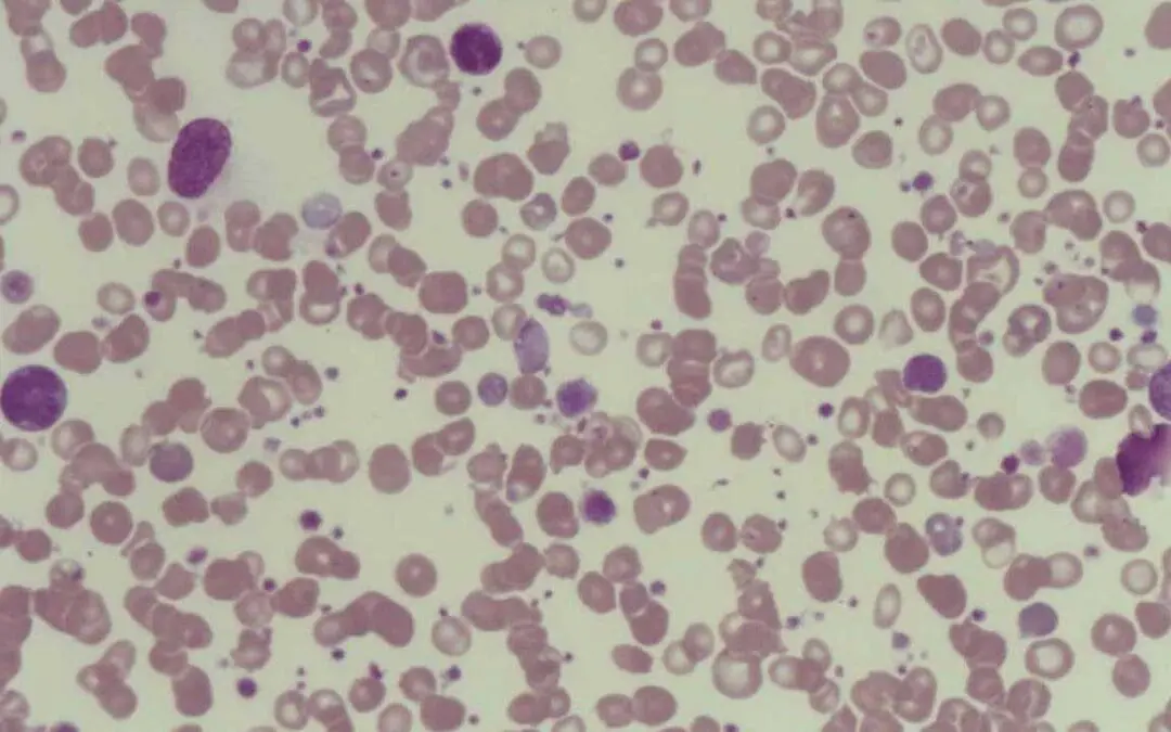 Platelet Function Disorders