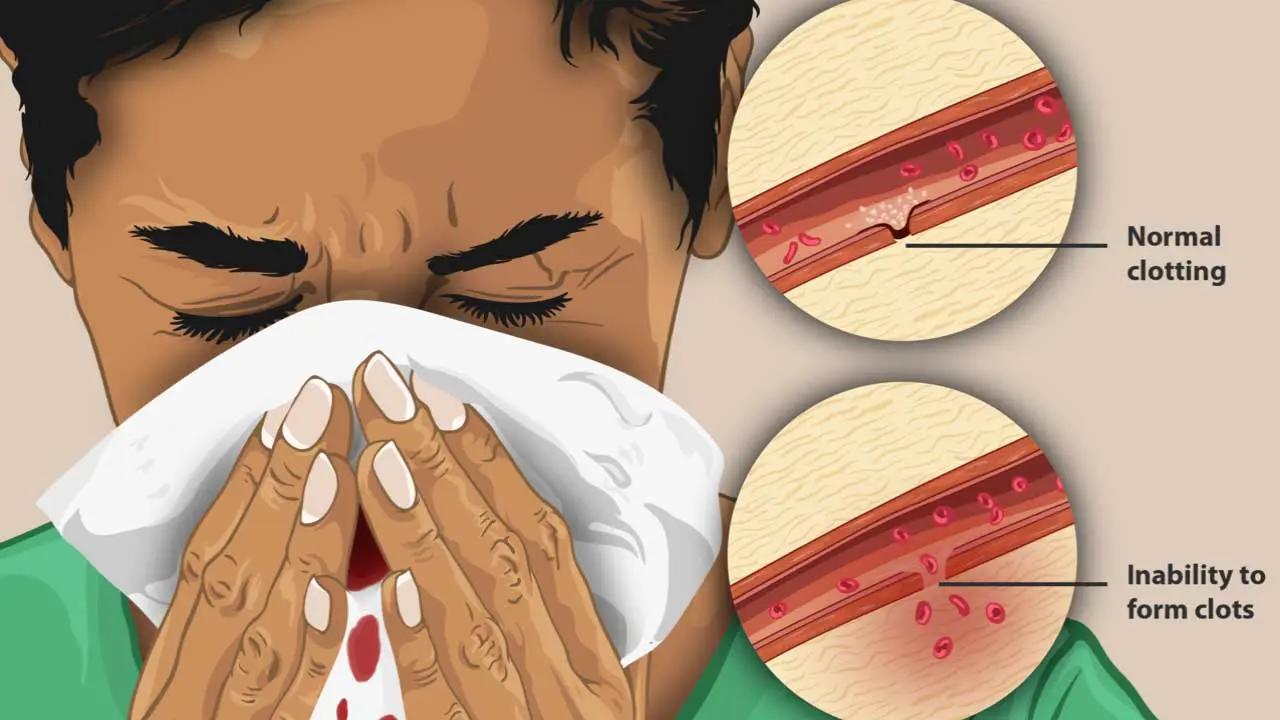 Coagulation disorders can lead to bleeding disorders due to the inability for blood clots to form properly like nose bleeds.