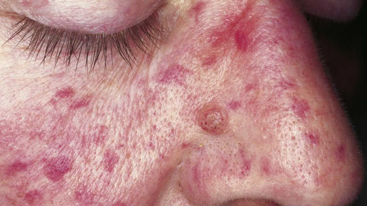Hereditary Hemorrhagic Telangiectasia (HHT)