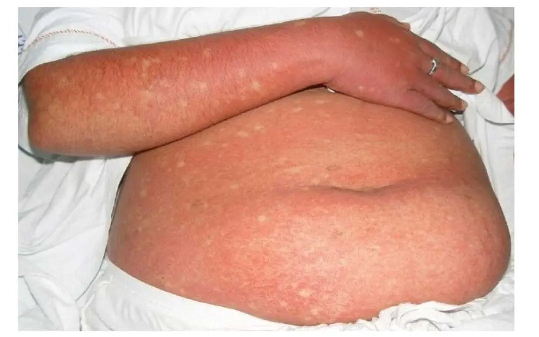Dengue & Thrombocytopenia