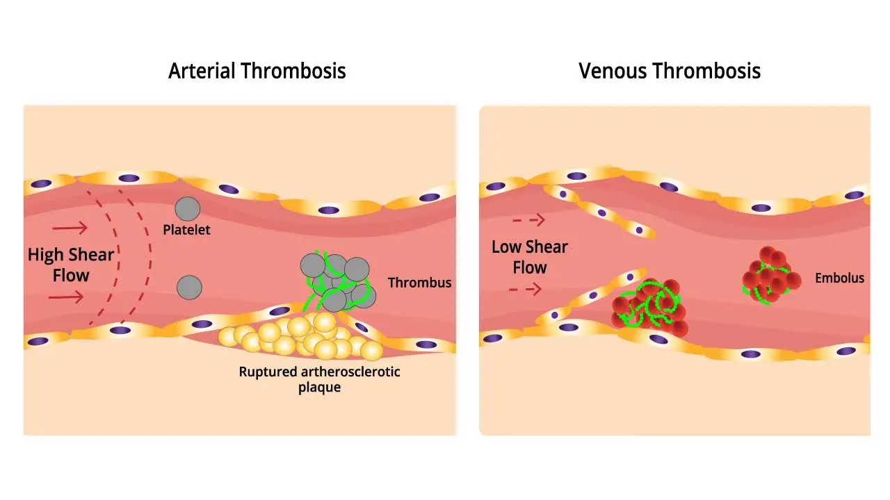 Pathophysiology of arterial and venous thrombosis.