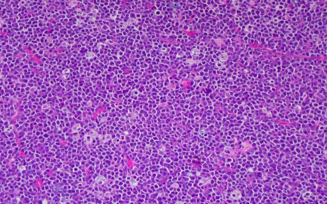 Burkitt Lymphoma