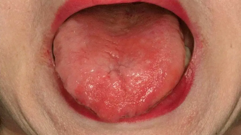 Glossitis can be a characteristic vitamin B12 deficiency symptom.