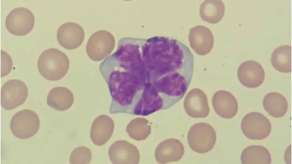 A lymphoma cell