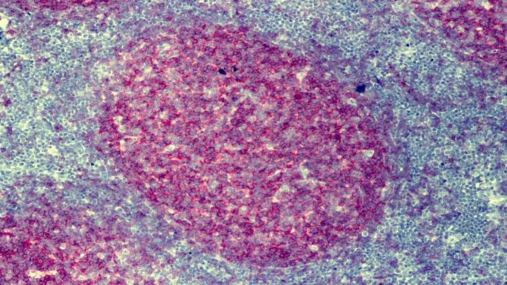 CD10 IHC positive stain