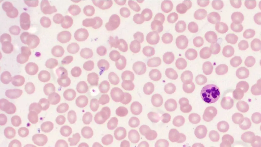 A peripheral blood smear in vitamin B12 deficiency reveals the presence of macrocytes, which are abnormally large red blood cells, with poikilocytosis. A hypersegmented neutrophil can also be seen. 