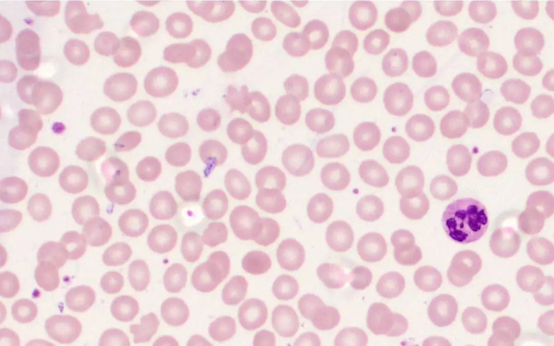 Vitamin B12 Deficiency Anemia