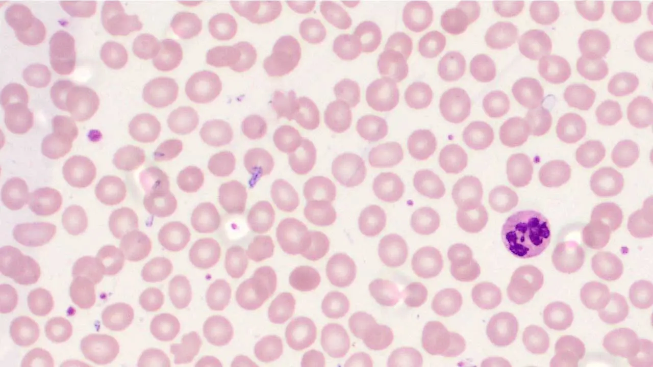 Vitamin B12 Deficiency Anemia