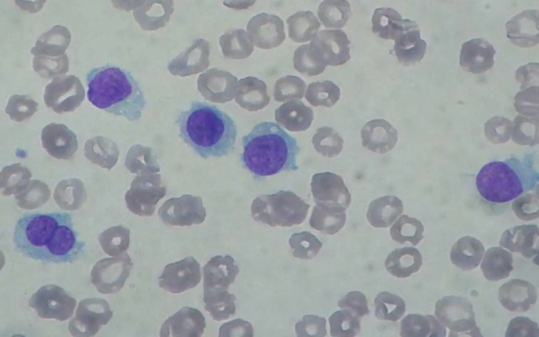 Hairy Cell Leukemia (HCL)