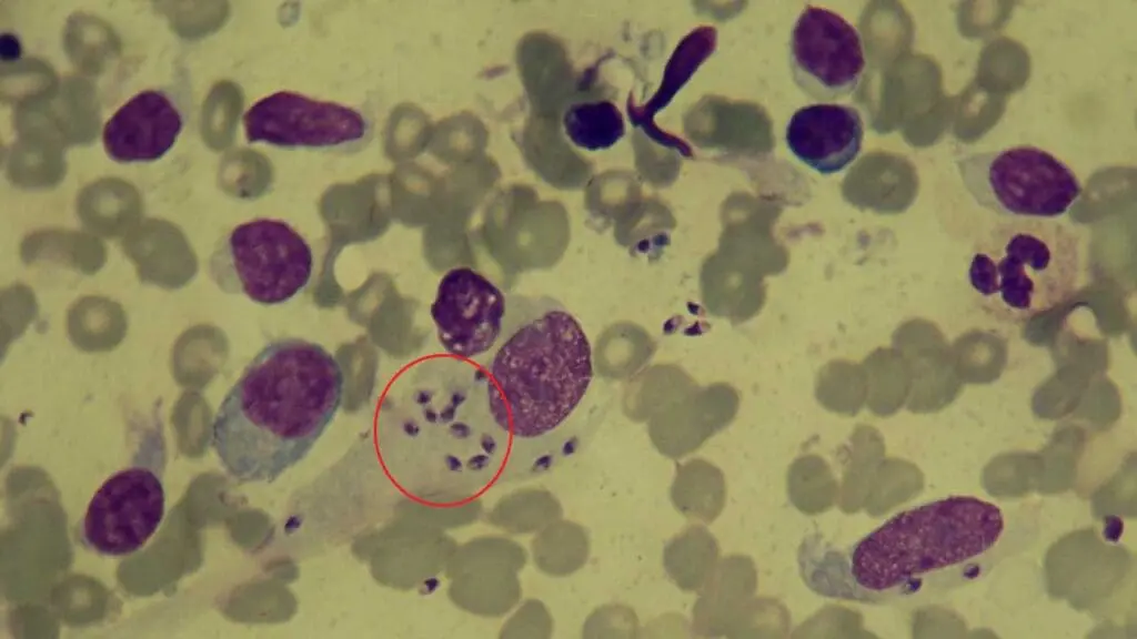 Leishman-Donovan bodies (red circle) in leishmaniasis infection.
