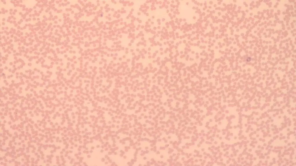 Peripheral blood smear with significant neutropenia under 100x magnification