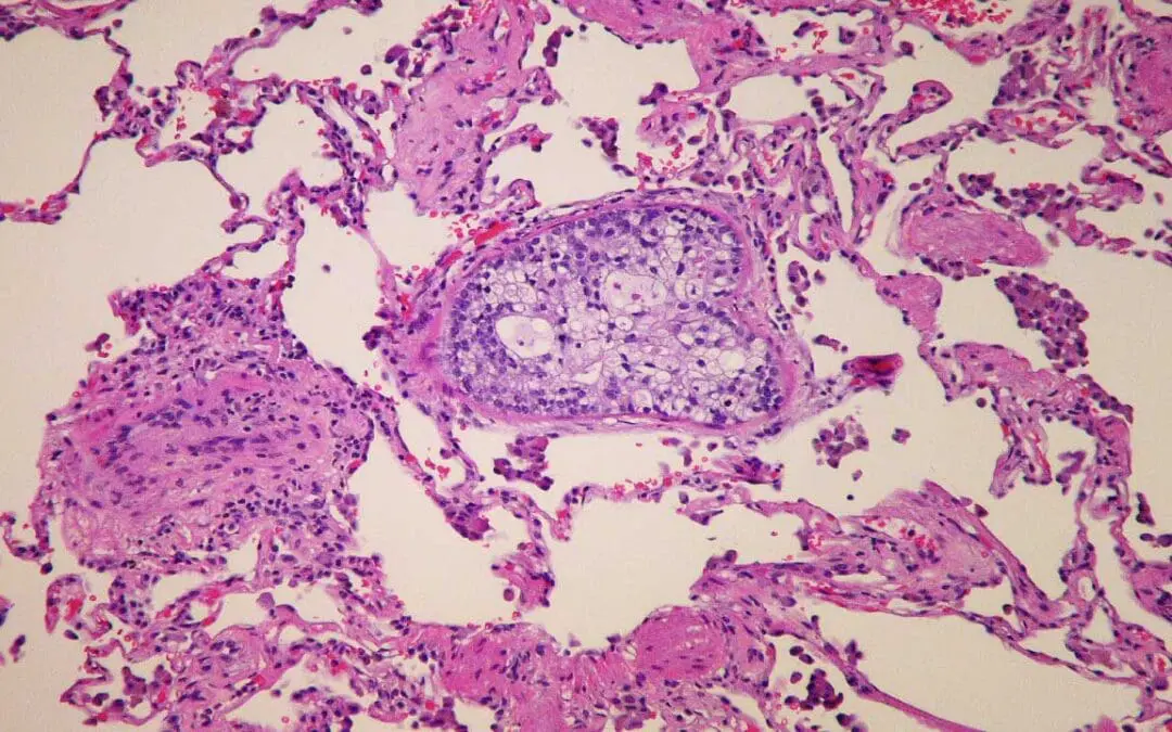 Embolus & Embolism