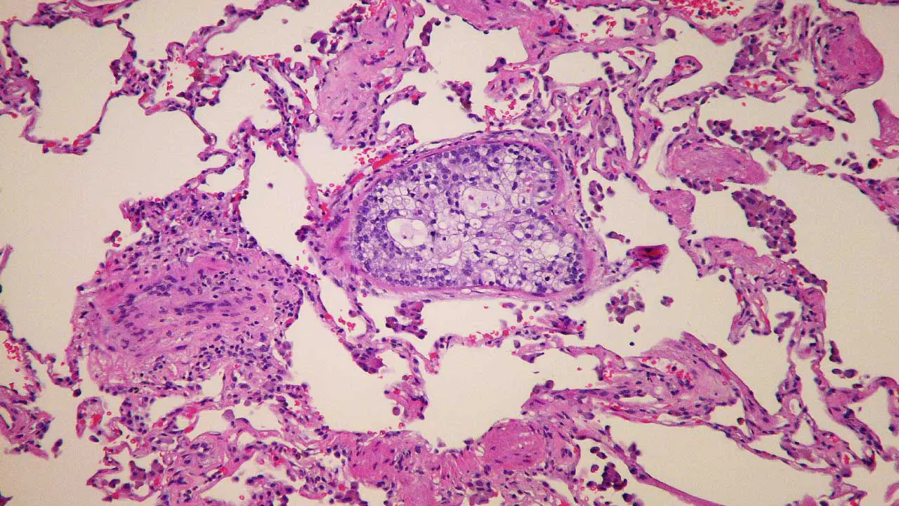 Embolus & Embolism