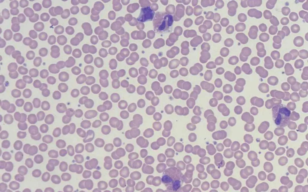 Causes of Eosinophilia (High Eosinophils)