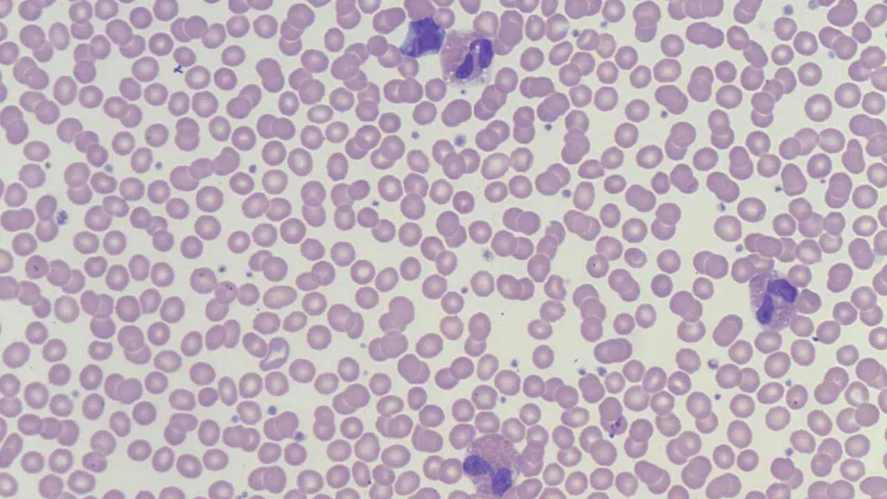 Causes of Eosinophilia (High Eosinophils)