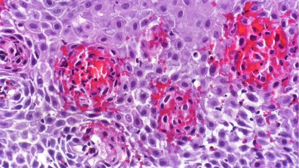 Eosinophilic esophagitis with prominent intraepithelial eosinophils, eosinophilic microabscesses, basal cell hyperplasia, elongation of the vascular papillae and marked intercellular edema. H&E Stain.
