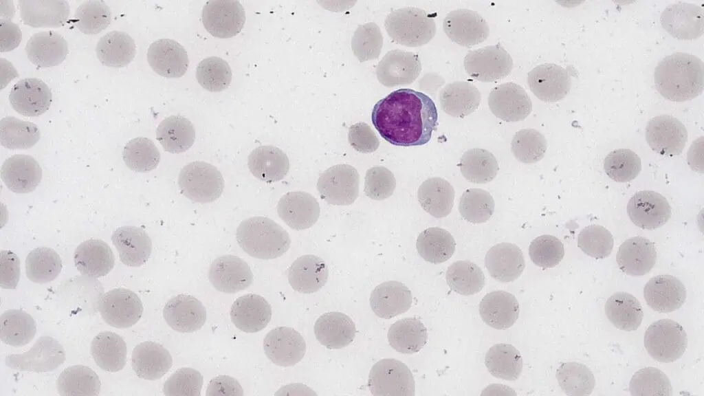 Normal lymphocytes are typically small cells with a large, dark, spherical nucleus that almost fills the cell, surrounded by a scant rim of pale blue cytoplasm.