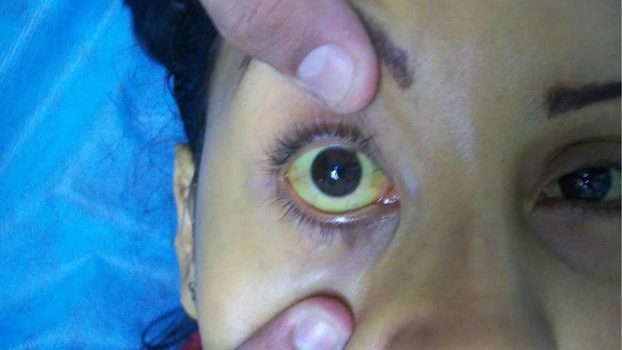 Jaundice (Hyperbilirubinemia)