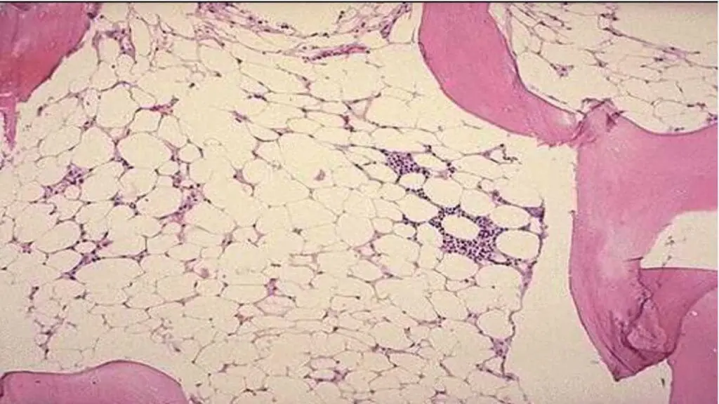 Aplastic anemia leads to lymphopenia (low lymphocytes) and hypocellular bone marrow.