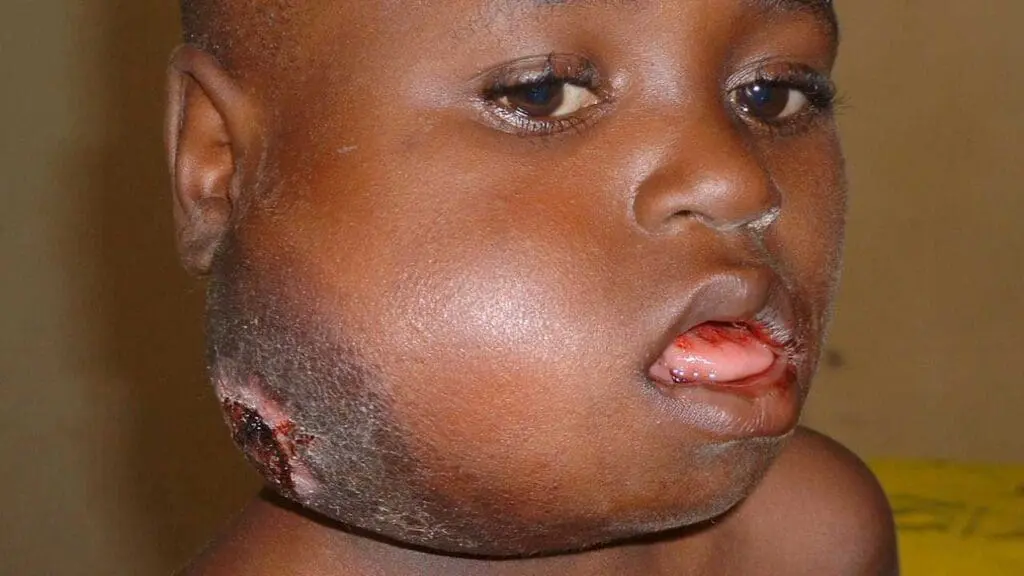 A 7 year old boy with a large facial tumor due to Burkitt lymphoma