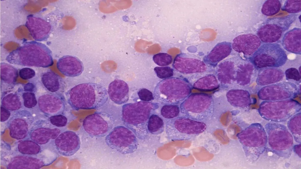 NK T-cell lymphoma is associated with the Epstein-Barr virus (EBV) and can spread to the lymph nodes in later stages. William R. Geddie. Source: Wellcome Collection.