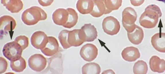 A peripheral blood smear which displayed basophilic stippling in red blood cells suggestive of lead poisoning. 