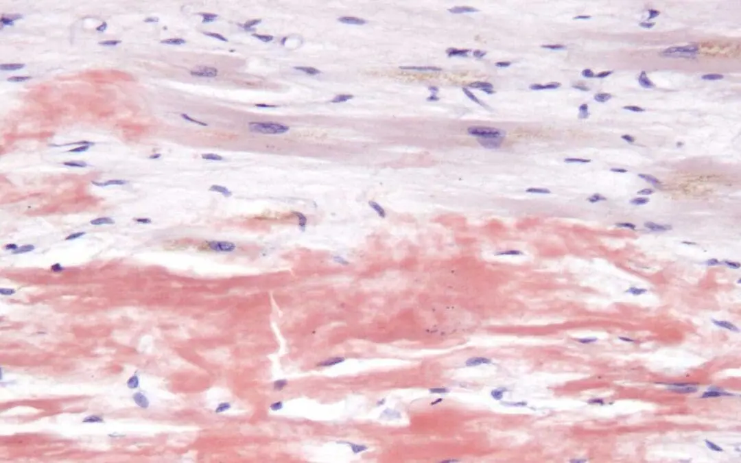 AL Amyloidosis (Primary Amyloidosis)